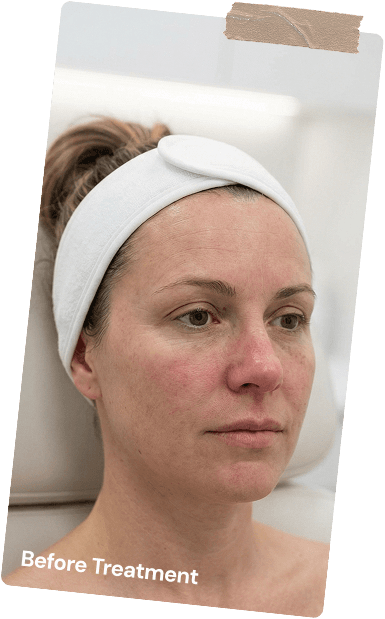 Before Treatment Preparation