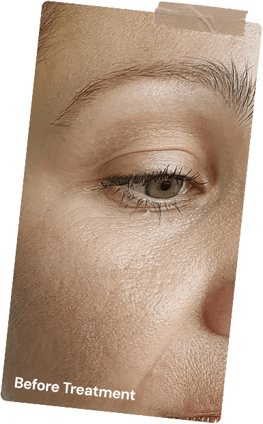Before Botox Treatment