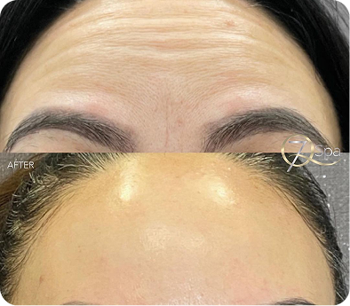 Botox transformation