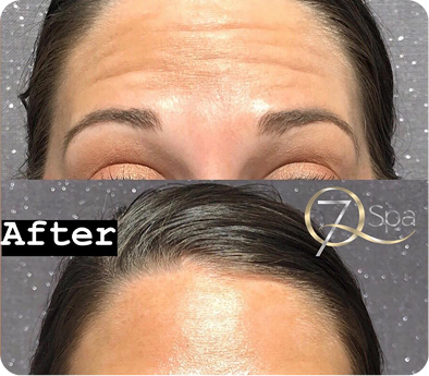 Botox transformation