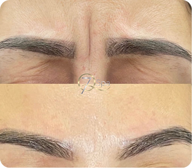 Botox transformation